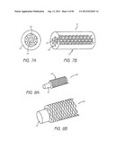 MINIMALLY INVASIVE TISSUE SUPPORT diagram and image