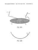 MINIMALLY INVASIVE TISSUE SUPPORT diagram and image