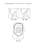 MINIMALLY INVASIVE TISSUE SUPPORT diagram and image