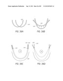 MINIMALLY INVASIVE TISSUE SUPPORT diagram and image