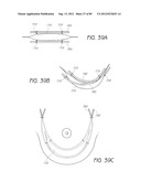 MINIMALLY INVASIVE TISSUE SUPPORT diagram and image