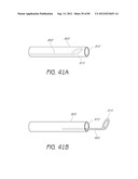 MINIMALLY INVASIVE TISSUE SUPPORT diagram and image