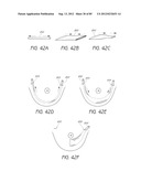 MINIMALLY INVASIVE TISSUE SUPPORT diagram and image