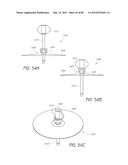 MINIMALLY INVASIVE TISSUE SUPPORT diagram and image