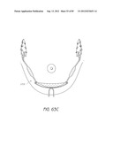 MINIMALLY INVASIVE TISSUE SUPPORT diagram and image