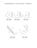 MINIMALLY INVASIVE TISSUE SUPPORT diagram and image