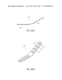 MINIMALLY INVASIVE TISSUE SUPPORT diagram and image