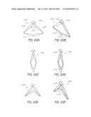 MINIMALLY INVASIVE TISSUE SUPPORT diagram and image