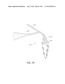 MINIMALLY INVASIVE TISSUE SUPPORT diagram and image