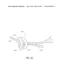 MINIMALLY INVASIVE TISSUE SUPPORT diagram and image