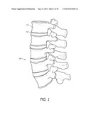 METHOD AND APPARATUS FOR MINIMALLY INVASIVE INSERTION OF INTERVERTEBRAL     IMPLANTS diagram and image