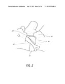 METHOD AND APPARATUS FOR MINIMALLY INVASIVE INSERTION OF INTERVERTEBRAL     IMPLANTS diagram and image