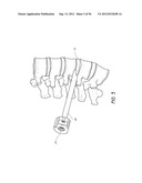 METHOD AND APPARATUS FOR MINIMALLY INVASIVE INSERTION OF INTERVERTEBRAL     IMPLANTS diagram and image