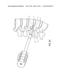 METHOD AND APPARATUS FOR MINIMALLY INVASIVE INSERTION OF INTERVERTEBRAL     IMPLANTS diagram and image