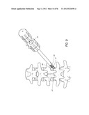 METHOD AND APPARATUS FOR MINIMALLY INVASIVE INSERTION OF INTERVERTEBRAL     IMPLANTS diagram and image