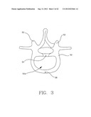 MULTI-LOBE ARTIFICIAL SPINE JOINT diagram and image