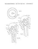 HUMERAL JOINT REPLACEMENT COMPONENT diagram and image