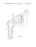 SHOULDER PROSTHETIC diagram and image