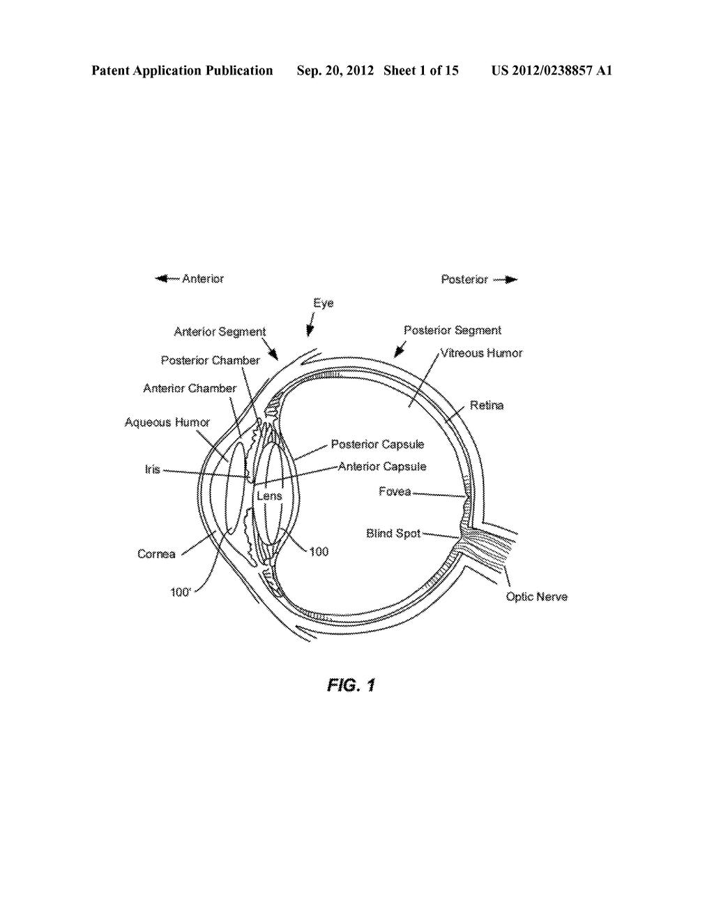 EXPANDABLE IMPLANTABLE PRESSURE SENSOR FOR INTRAOCULAR SURGERY - diagram, schematic, and image 02