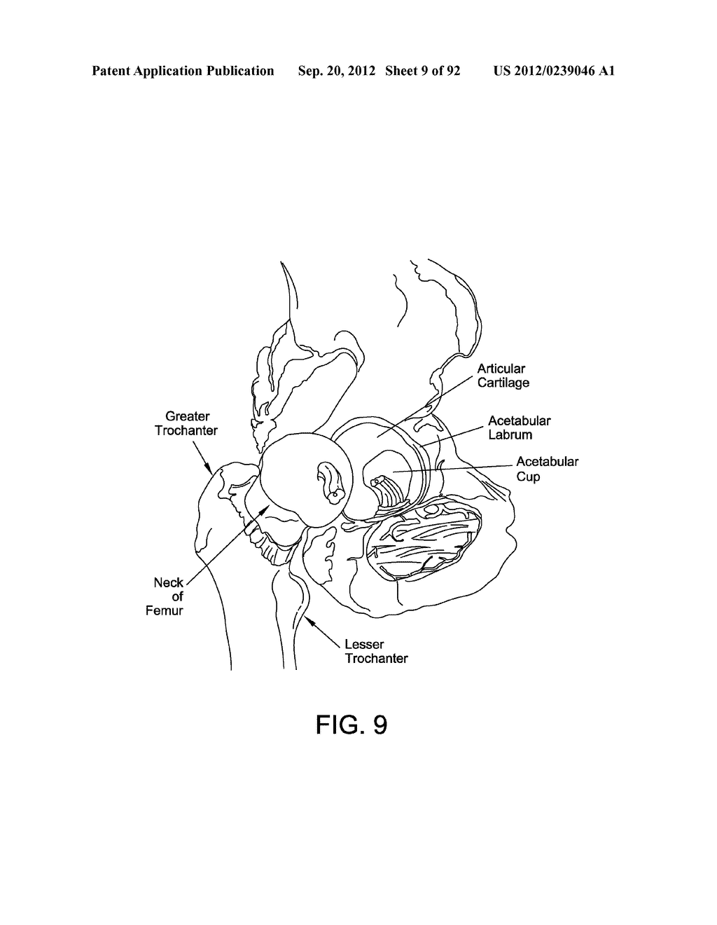 METHOD AND APPARATUS FOR DISTRACTING A JOINT - diagram, schematic, and image 10