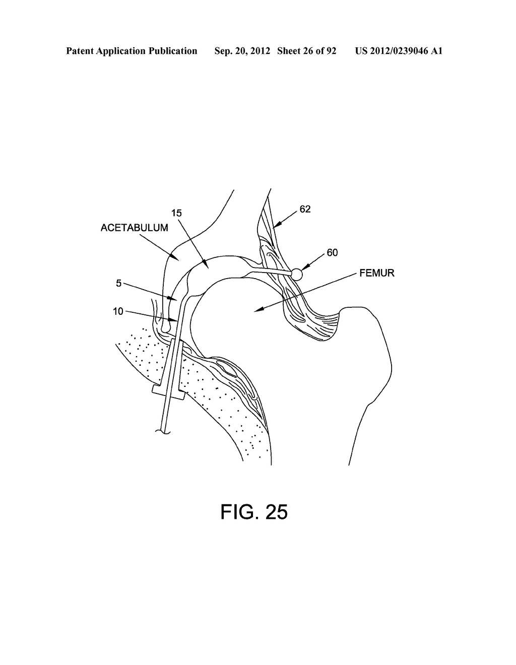 METHOD AND APPARATUS FOR DISTRACTING A JOINT - diagram, schematic, and image 27