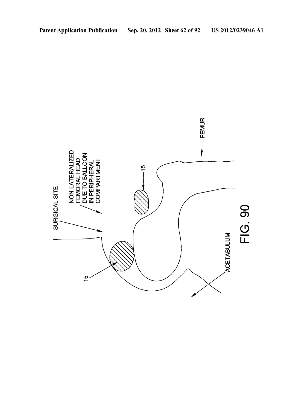 METHOD AND APPARATUS FOR DISTRACTING A JOINT - diagram, schematic, and image 63