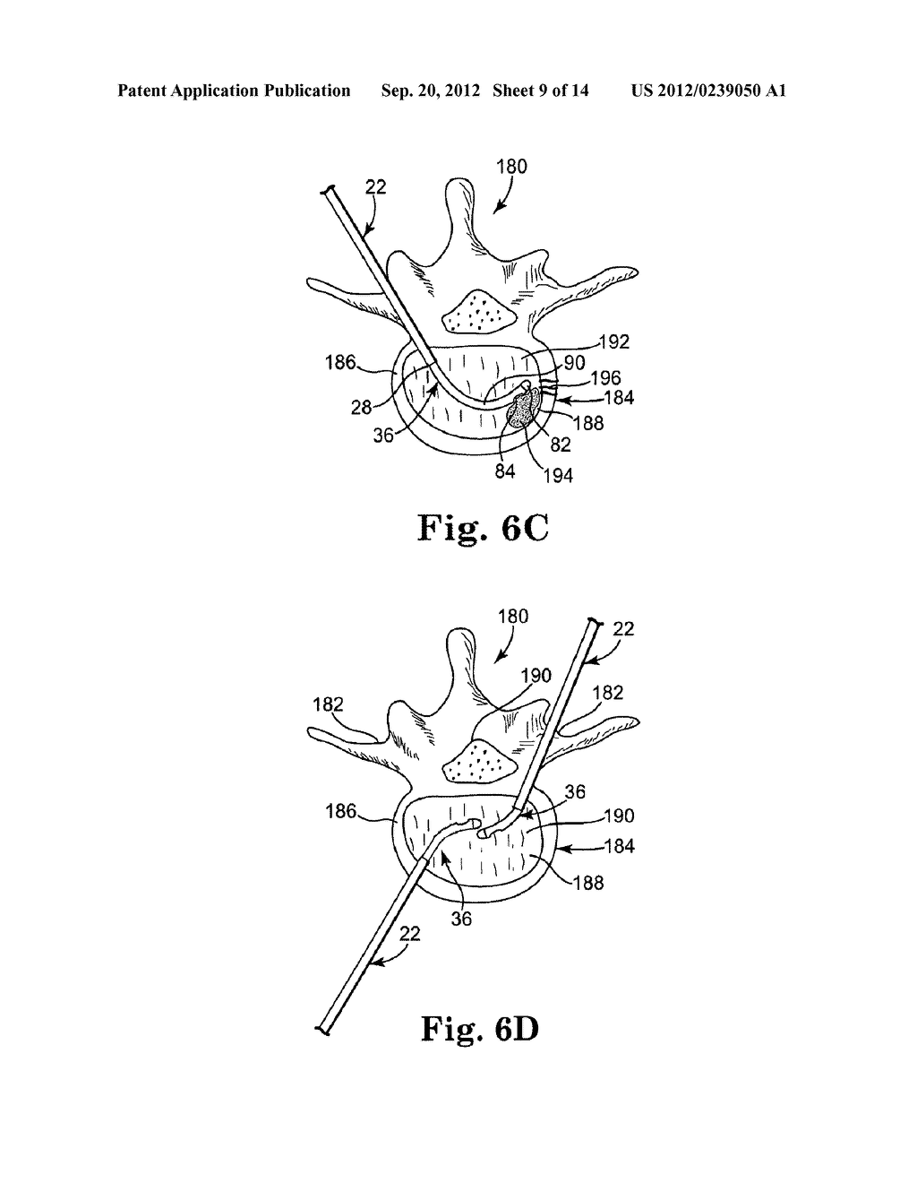 MULTISTATE-CURVATURE DEVICE AND METHOD FOR DELIVERING A CURABLE MATERIAL     INTO BONE - diagram, schematic, and image 10