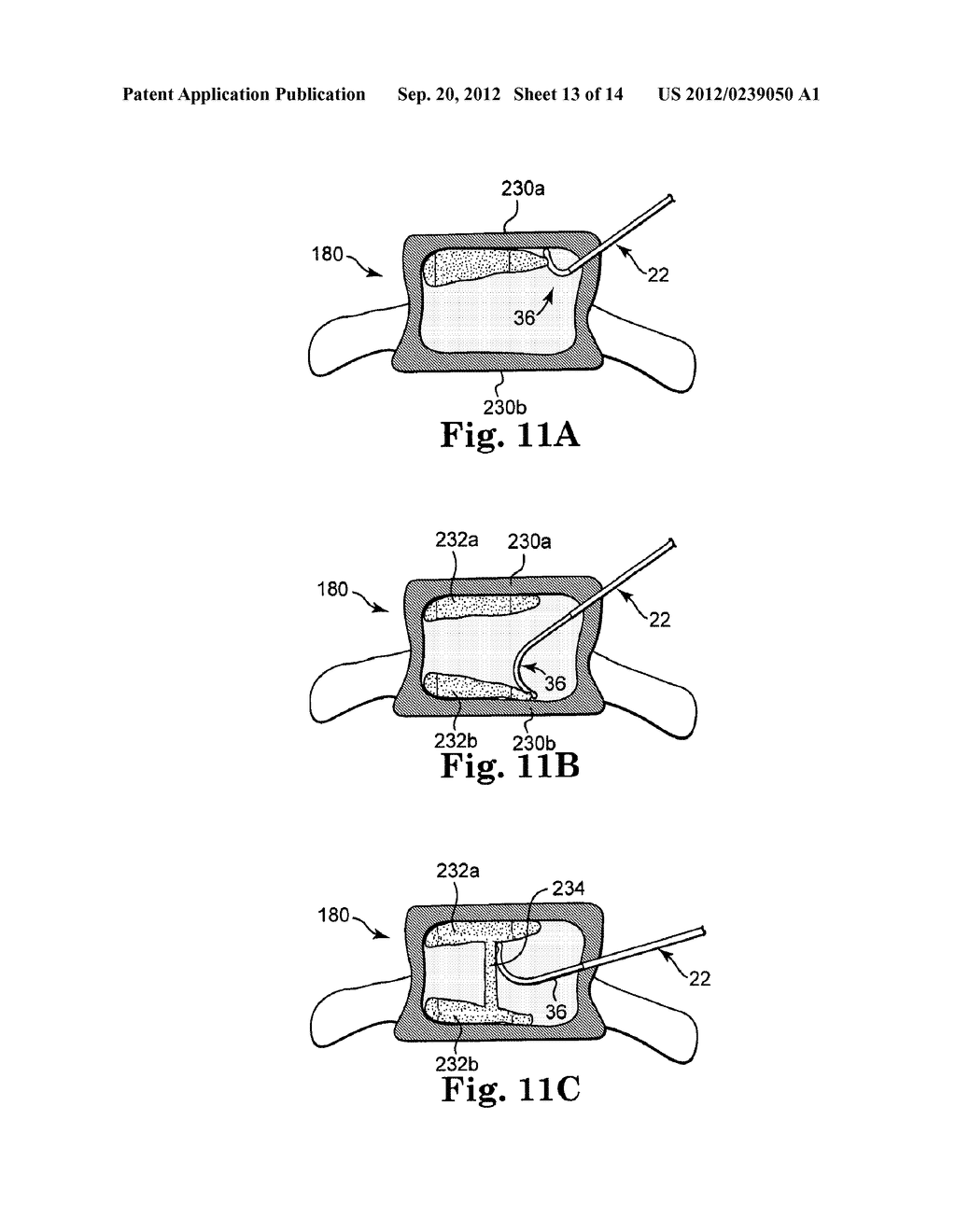 MULTISTATE-CURVATURE DEVICE AND METHOD FOR DELIVERING A CURABLE MATERIAL     INTO BONE - diagram, schematic, and image 14