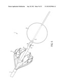 DEVICE AND METHOD FOR REMOVING MATERIAL FROM A HOLLOW ANATOMICAL STRUCTURE diagram and image