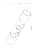 DEVICE AND METHOD FOR REMOVING MATERIAL FROM A HOLLOW ANATOMICAL STRUCTURE diagram and image