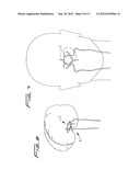 ROTATIONAL THROMBECTOMY WIRE COUPLER diagram and image