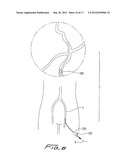 ROTATIONAL THROMBECTOMY WIRE COUPLER diagram and image