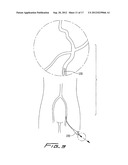 ROTATIONAL THROMBECTOMY WIRE COUPLER diagram and image