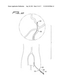 ROTATIONAL THROMBECTOMY WIRE COUPLER diagram and image