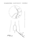 ROTATIONAL THROMBECTOMY WIRE COUPLER diagram and image