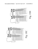 SPINAL MOTION PRESERVATION DEVICES AND METHODS OF USE diagram and image