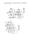 SPINAL MOTION PRESERVATION DEVICES AND METHODS OF USE diagram and image