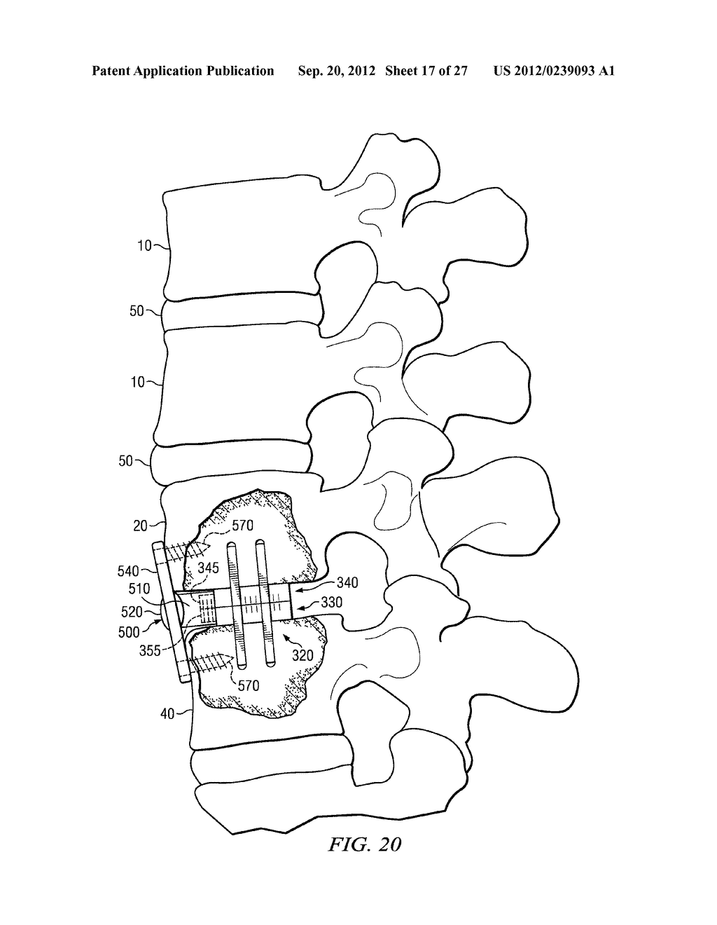 SPONDYLOLISTHESIS CORRECTION APPARATUS AND METHOD - diagram, schematic, and image 18