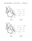 IMPLANTABLE MEDICAL DEVICE FOR CARDIAC THERAPY diagram and image