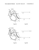 IMPLANTABLE MEDICAL DEVICE FOR CARDIAC THERAPY diagram and image