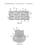 APPARATUS AND METHODS TO ENHANCE BONDING IN ENDOLUMINAL PROSTHESES diagram and image