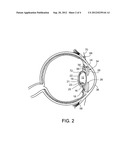 Aberration-Correcting Vision Prosthesis diagram and image