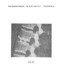 Friction Fit and Vertebral Endplate-Preserving Spinal Implant diagram and image