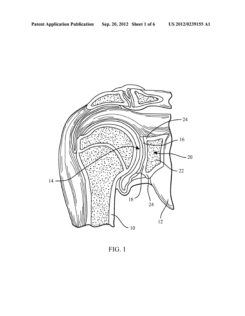 CIRCULAR GLENOID METHOD FOR SHOULDER ARTHROPLASTY - diagram, schematic, and image 02