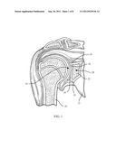 REVISION GLENOID DEVICE AND METHOD diagram and image