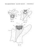 REVISION GLENOID DEVICE AND METHOD diagram and image