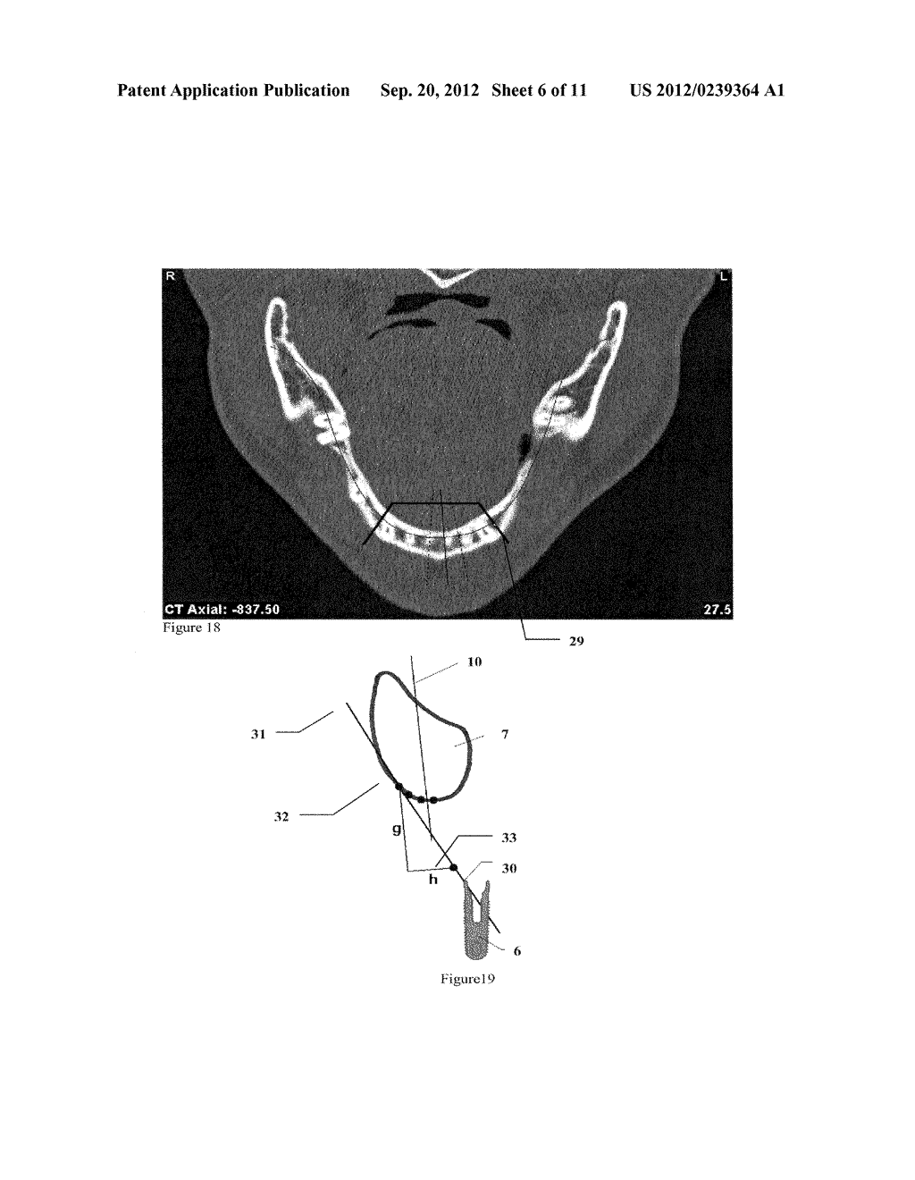 METHOD FOR (SEMI-) AUTOMATIC DENTAL IMPLANT PLANNING - diagram, schematic, and image 07