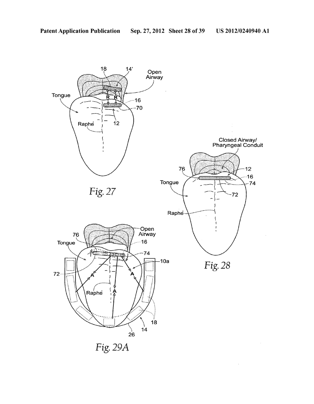 DEVICES, SYSTEMS AND METHODS USING MAGNETIC FORCE SYSTEMS AFFECTING THE     TOUNGUE OR HYOID MUSCCLES IN THE UPPER AIRWYA - diagram, schematic, and image 29