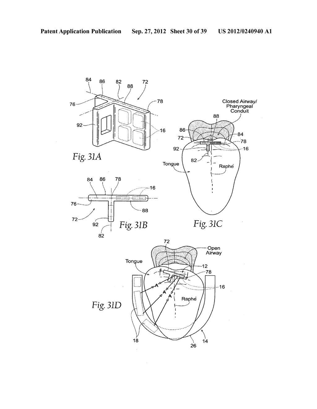 DEVICES, SYSTEMS AND METHODS USING MAGNETIC FORCE SYSTEMS AFFECTING THE     TOUNGUE OR HYOID MUSCCLES IN THE UPPER AIRWYA - diagram, schematic, and image 31