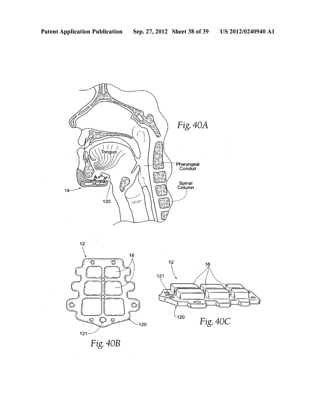 DEVICES, SYSTEMS AND METHODS USING MAGNETIC FORCE SYSTEMS AFFECTING THE     TOUNGUE OR HYOID MUSCCLES IN THE UPPER AIRWYA - diagram, schematic, and image 39